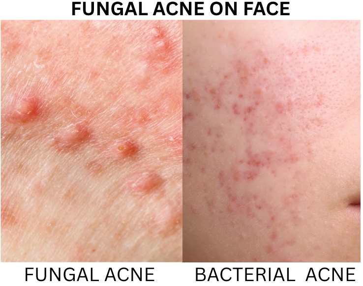Exploding Infected Pimples Fungal Acne Pictures: A Doctor's guide to spot on Face, Body