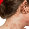 Perioral dermatitis healing stages