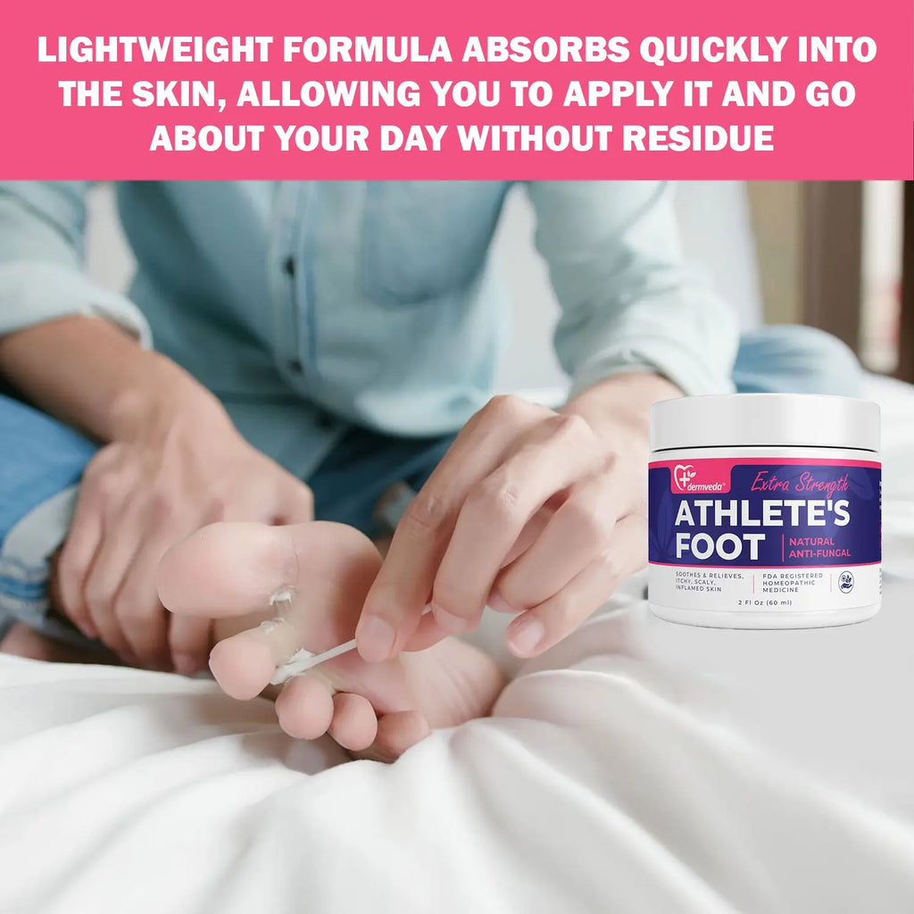 Applying antifungal cream to foot for Athlete's foot treatment.