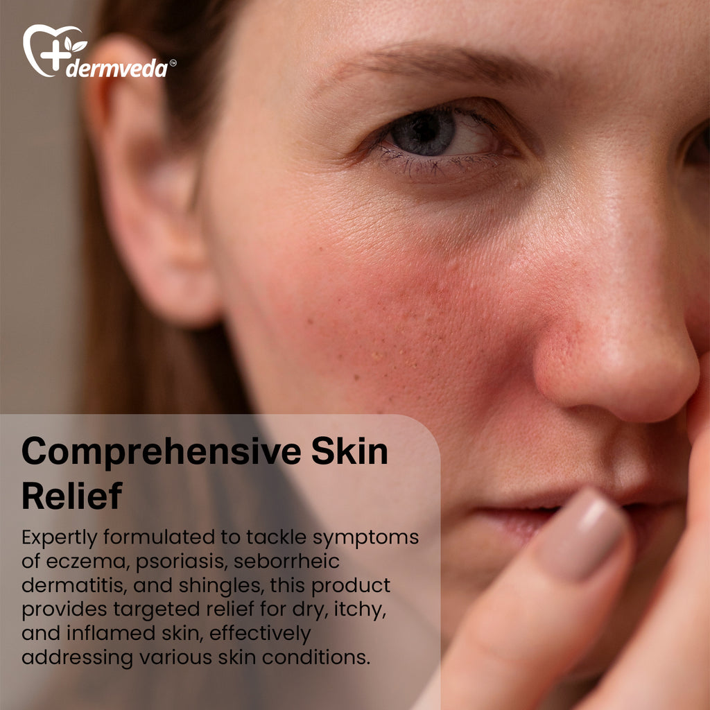 Woman applying Dermveda cream on shingles rash – natural relief with turmeric, sulfur, and peppermint