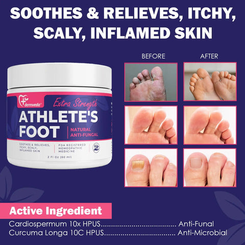 Athletes foot cream showing before and after results for fungal relief.