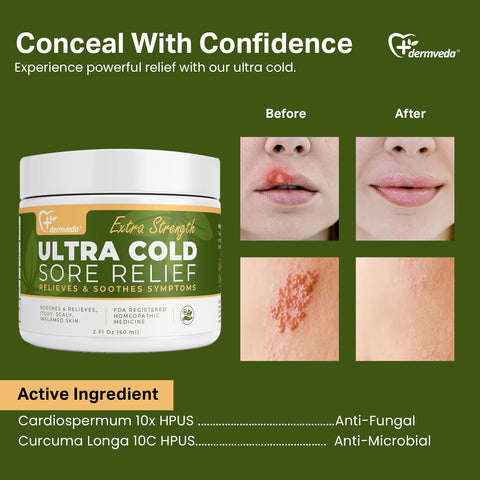 Dermveda Ultra Cold Sore Relief cream for treatment, shown with before and after healing.