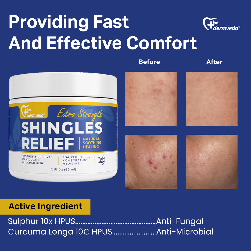 Before and after using Dermveda cream – visible reduction in shingles rash redness and inflammation