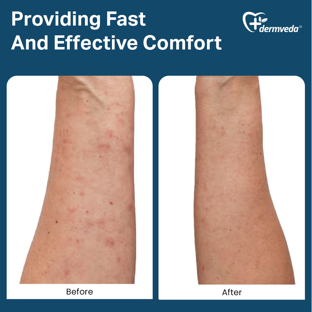 Side-by-side comparison of irritated skin with red bumps and smooth, healed skin after using Dermveda Ultra Bite Itch Relief