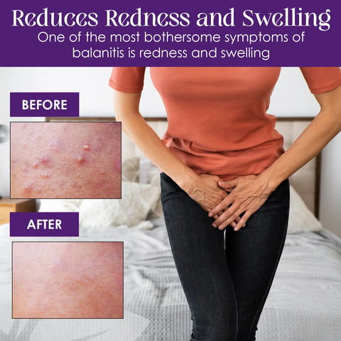 Balanitis relief cream results: reduced redness and swelling