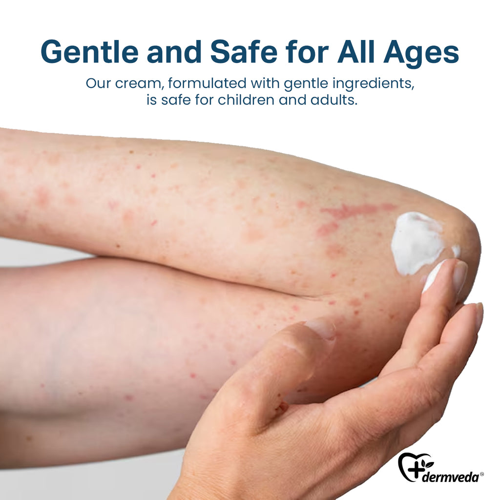 Image depicting skin with raised red welts caused by hives due to insect bites, highlighting allergic reaction symptoms