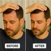 Psoriasis Seborrheic treatment cream before after
