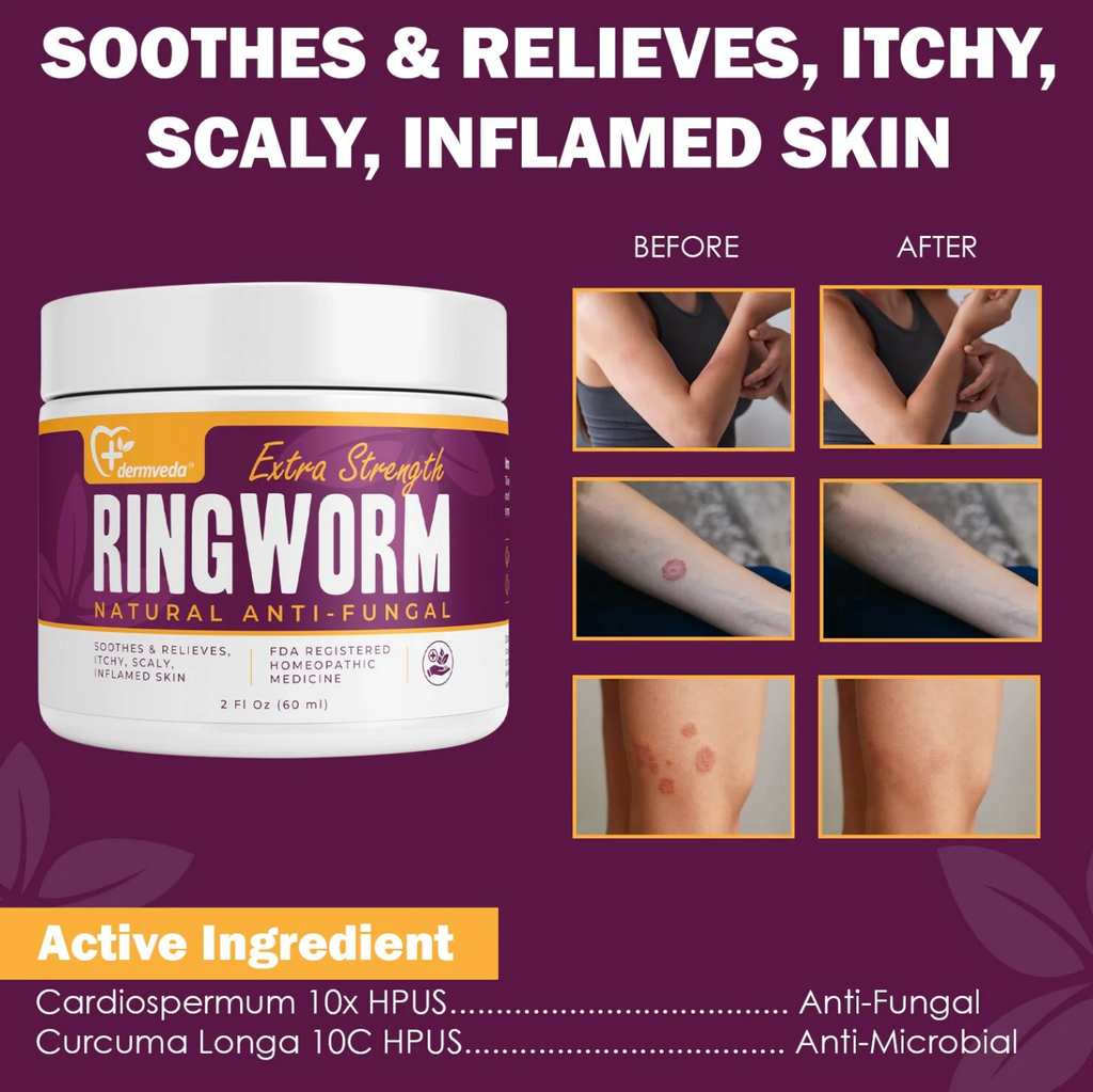 Dermveda ringworm treatment showing before and after skin results