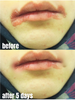 Dermveda Angular Cheilitis Cream – Natural Relief for Cracked Lips