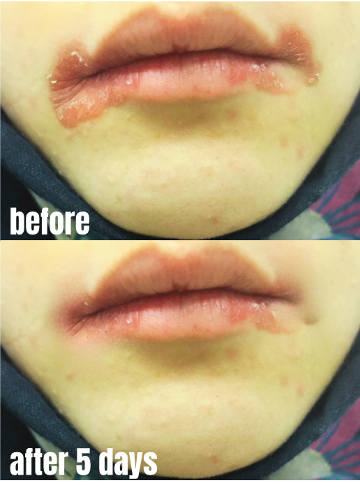 Dermveda Angular Cheilitis Cream – Natural Relief for Cracked Lips
