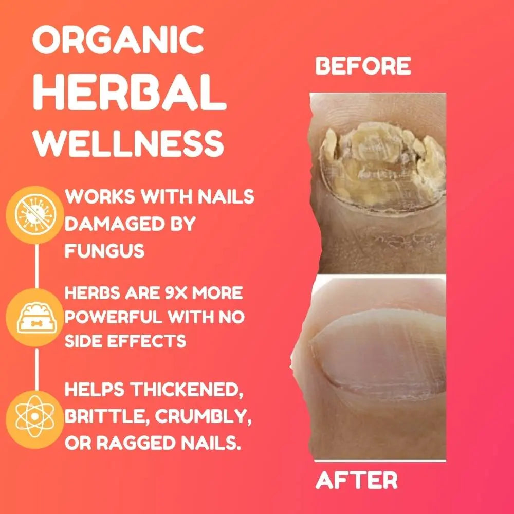Toenail Fungus Damaged Nail Restorative Solution.